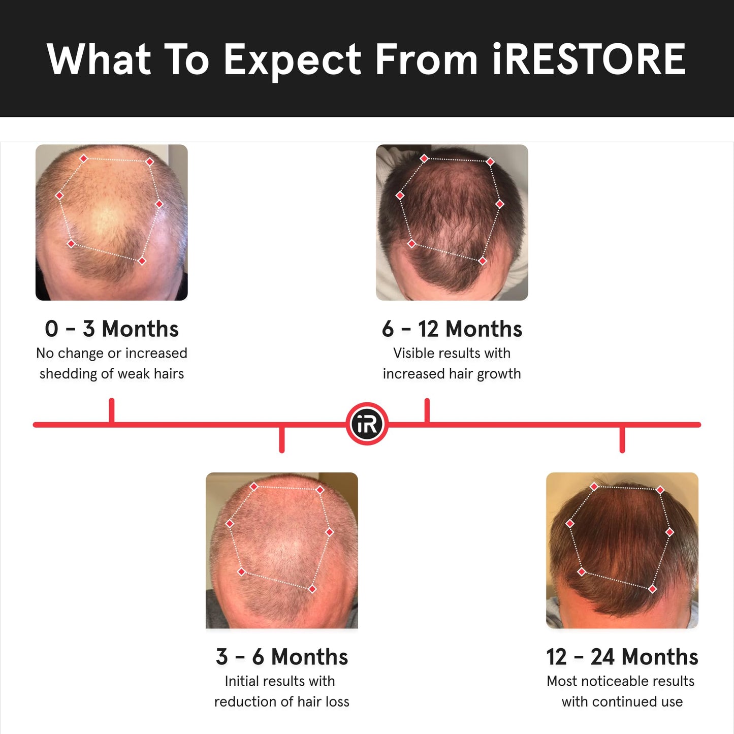 iRestore Essential - Laser Red Light Therapy for Hair Growth - FDA Cleared Hair Loss, Hair Thinning & Alopecia Treatment for Men & Women - Laser Cap for Hair Regrowth Stimulate Denser Fuller Hair