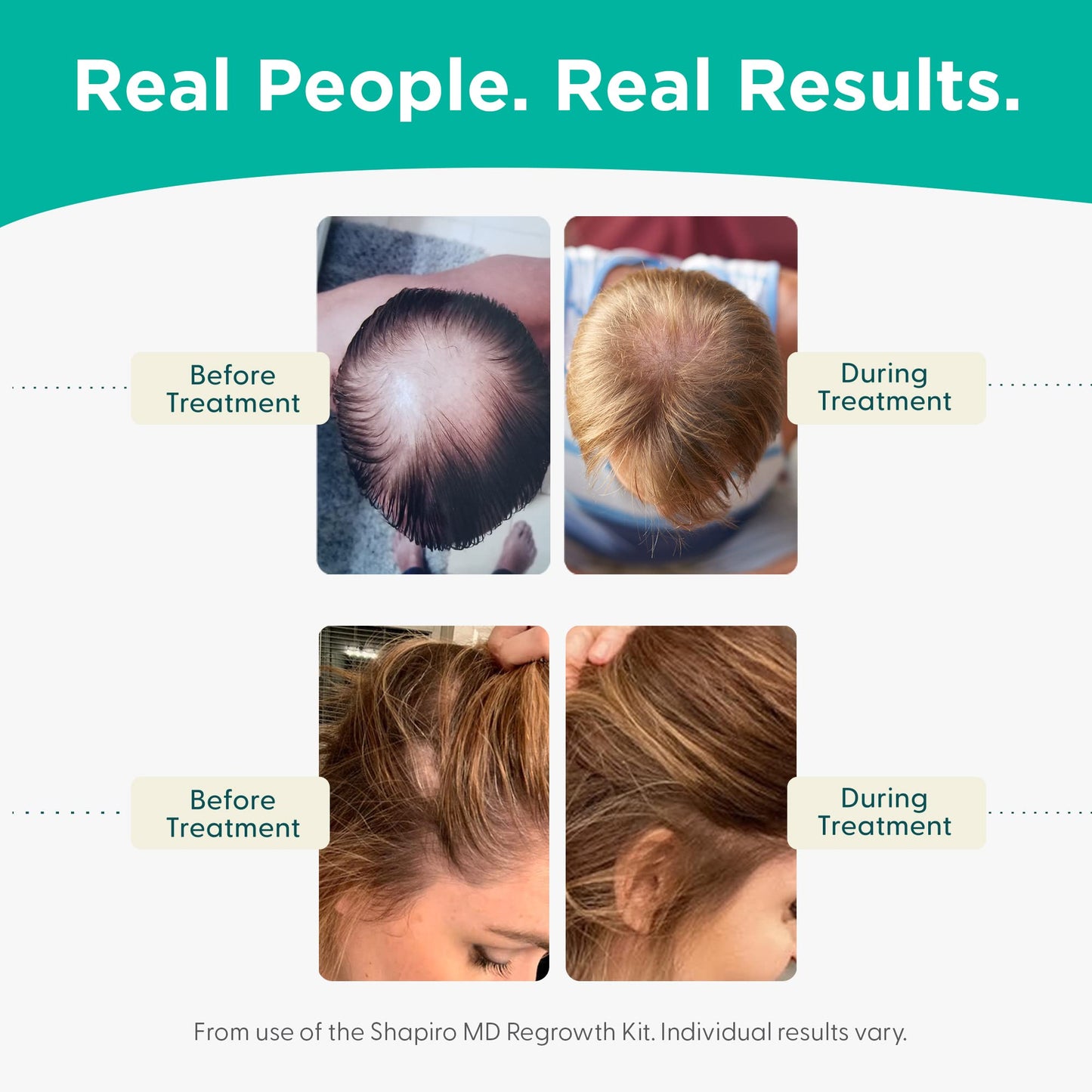Shapiro MD Hair Growth Experts Hair Loss Shampoo and Conditioner, DHT Fighting Vegan Formula for Thinning Hair Developed by Dermatologists, Experience Healthier, Fuller Thicker Hair, 4 Month Supply
