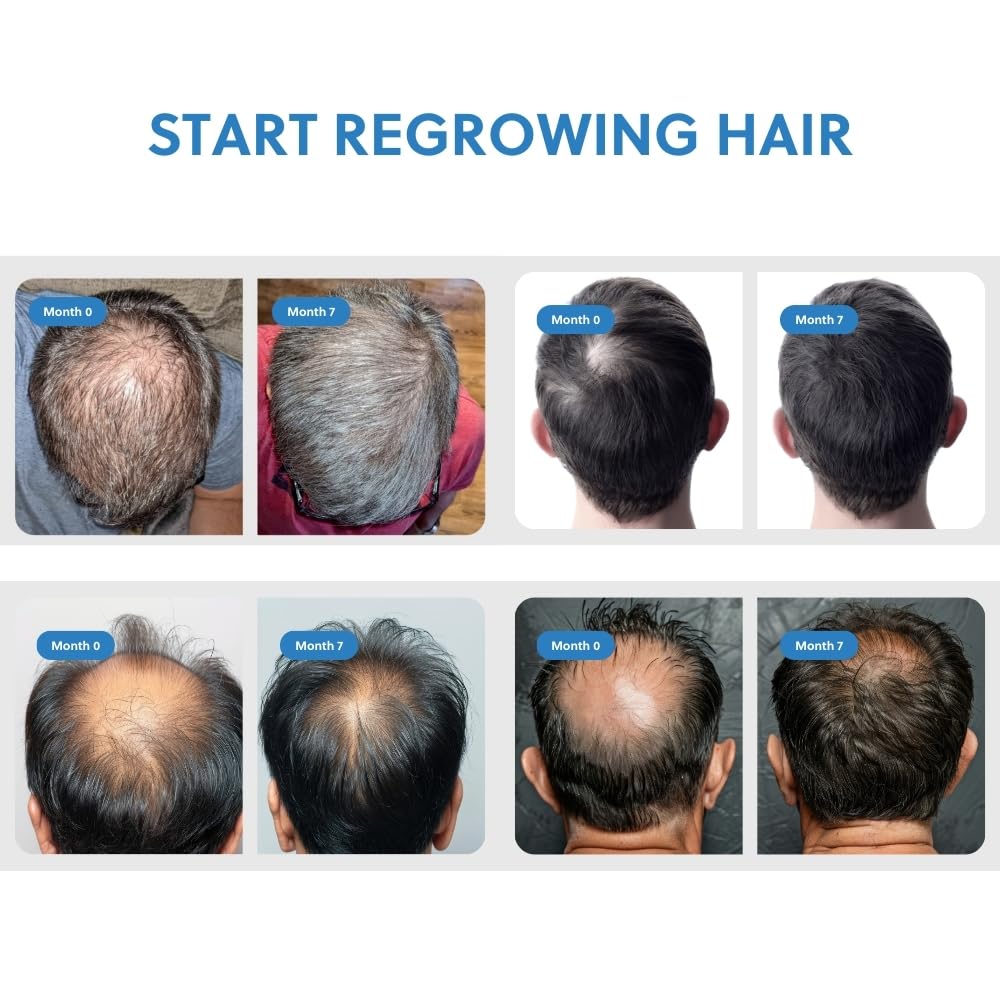 Men's Hair Regrowth Spray - Advanced Hair Loss Solution - Promotes Hair Growth and Strengthening, Non-Greasy and Hormone-Free Formula