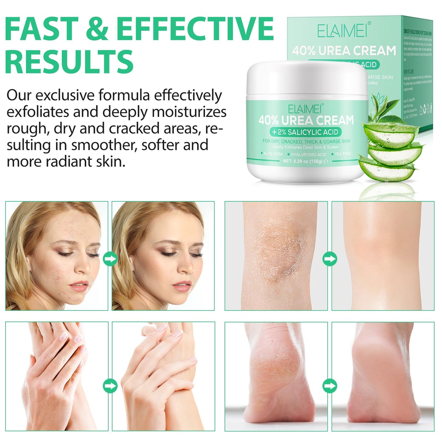 Urea Cream 40 Percent for Feet Maximum Strength,40% Urea Cream Plus 2% Salicylic Acid,Foot Cream and Hand Cream with Tea Tree,and Aloe Vera(5.29 OZ/150g/2pack)