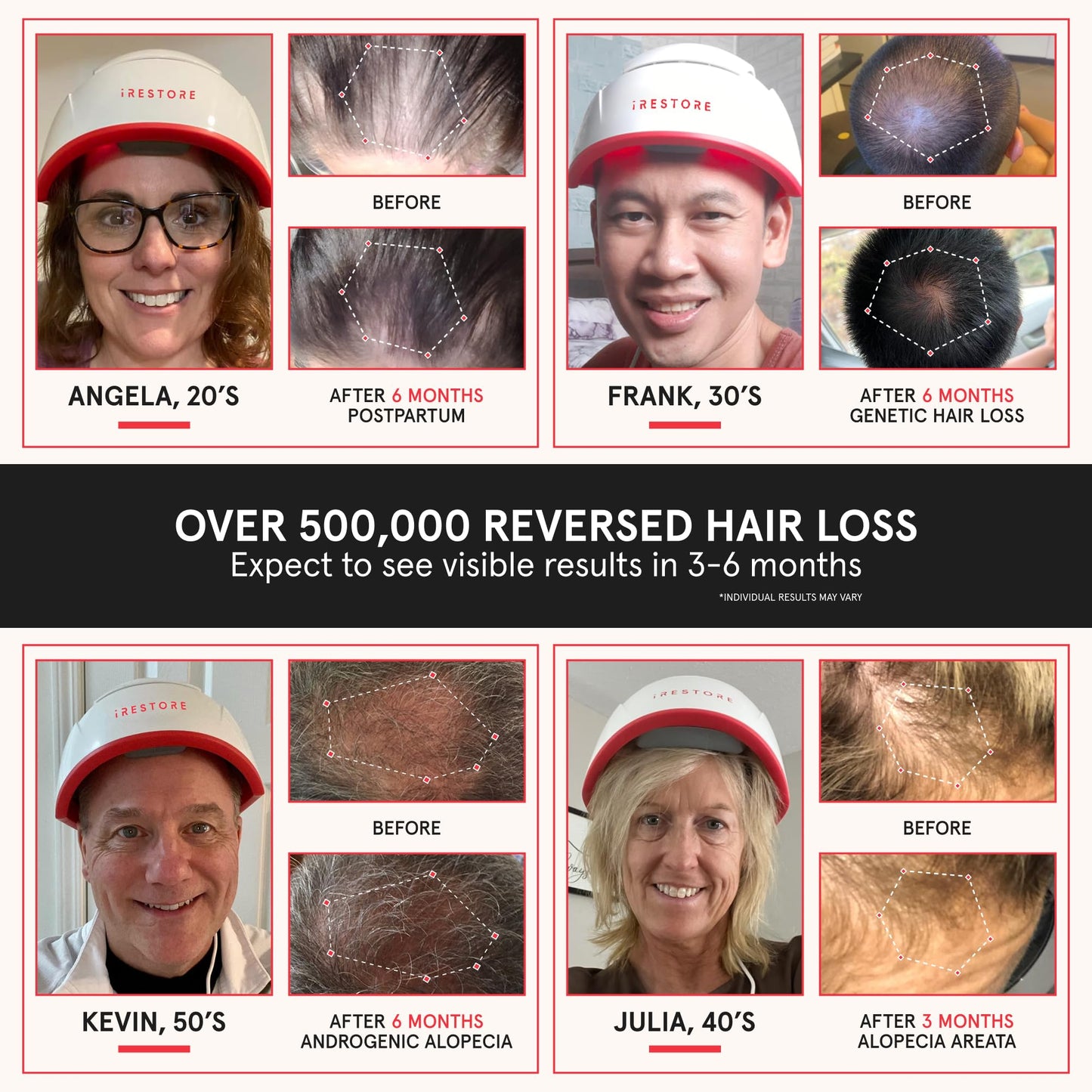 iRestore Professional + Rechargeable Battery Pack - Laser Red Light Therapy for Hair Growth - FDA Cleared Hair Loss, Thinning Treatment for Men & Women - Hair Regrowth Cap - 282 Lasers & LEDs