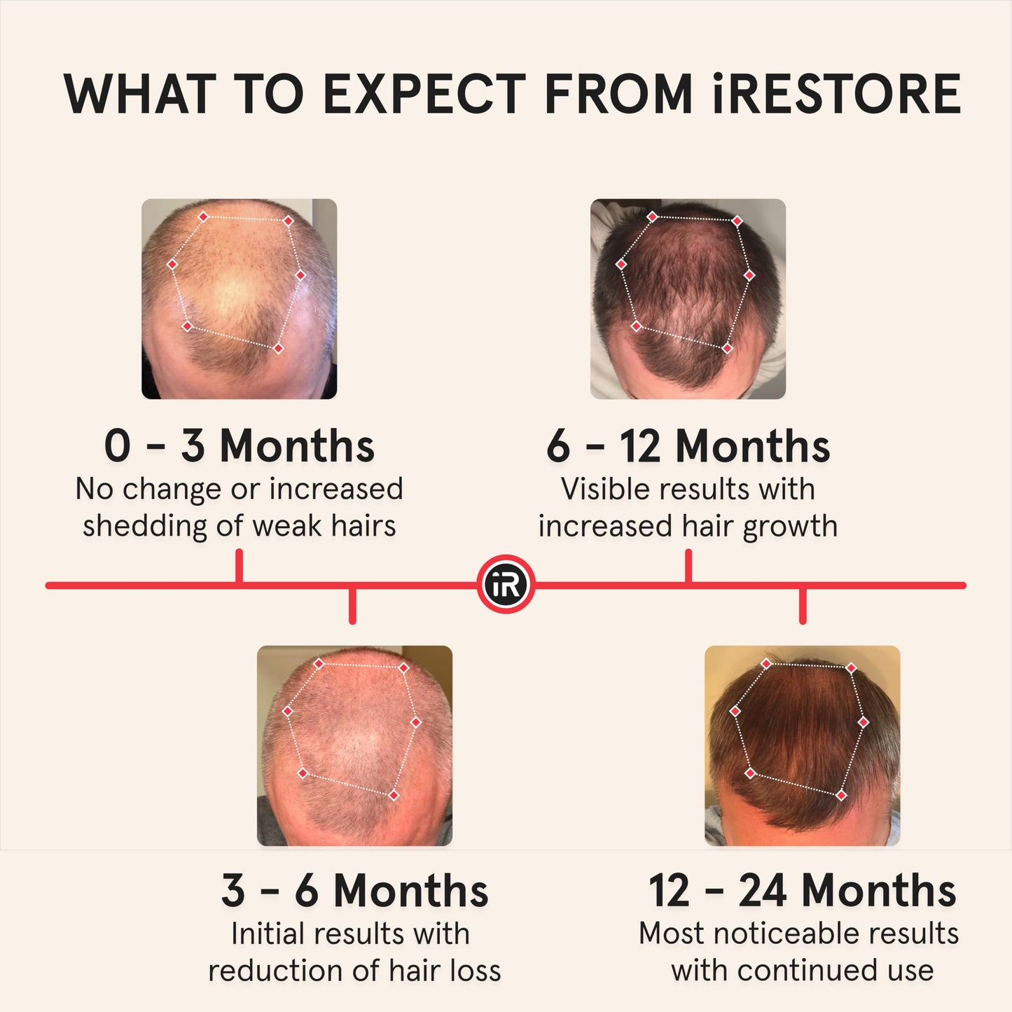 iRestore Professional Laser Red Light Therapy for Hair Growth System - FDA Cleared Hair Loss, Hair Thinning & Alopecia Treatment for Men & Women - Laser Cap for Hair Regrowth - 282 Lasers & LEDs