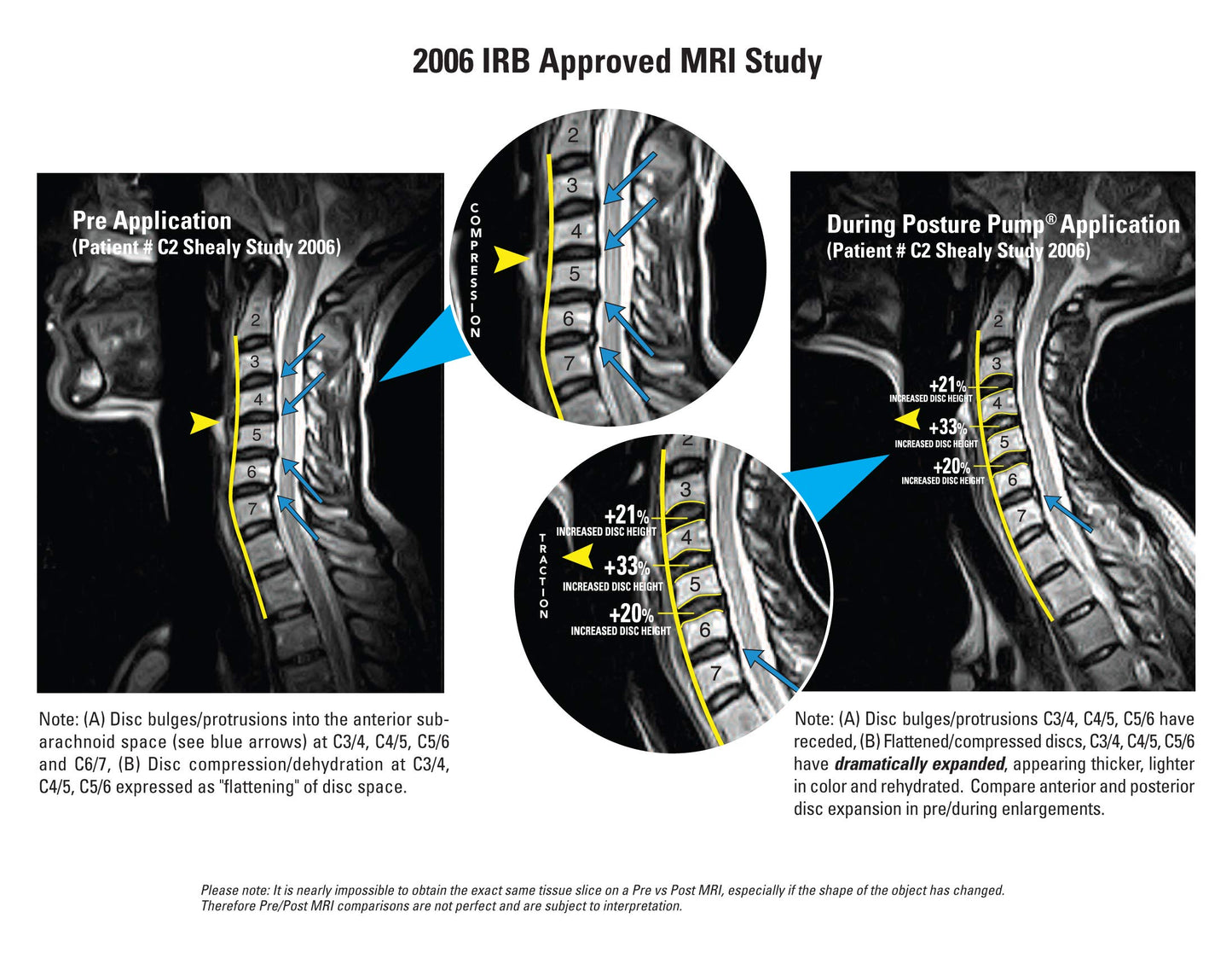 Posture Pump® Dual Deluxe Neck & Back Exercising Cervical Spine Hydrator Pump | Relieves Neck, Upper Back, & Low Back Pain Stiffness | Tech Neck Relief Posture Control (Dual Full Spine Model 4100-D)