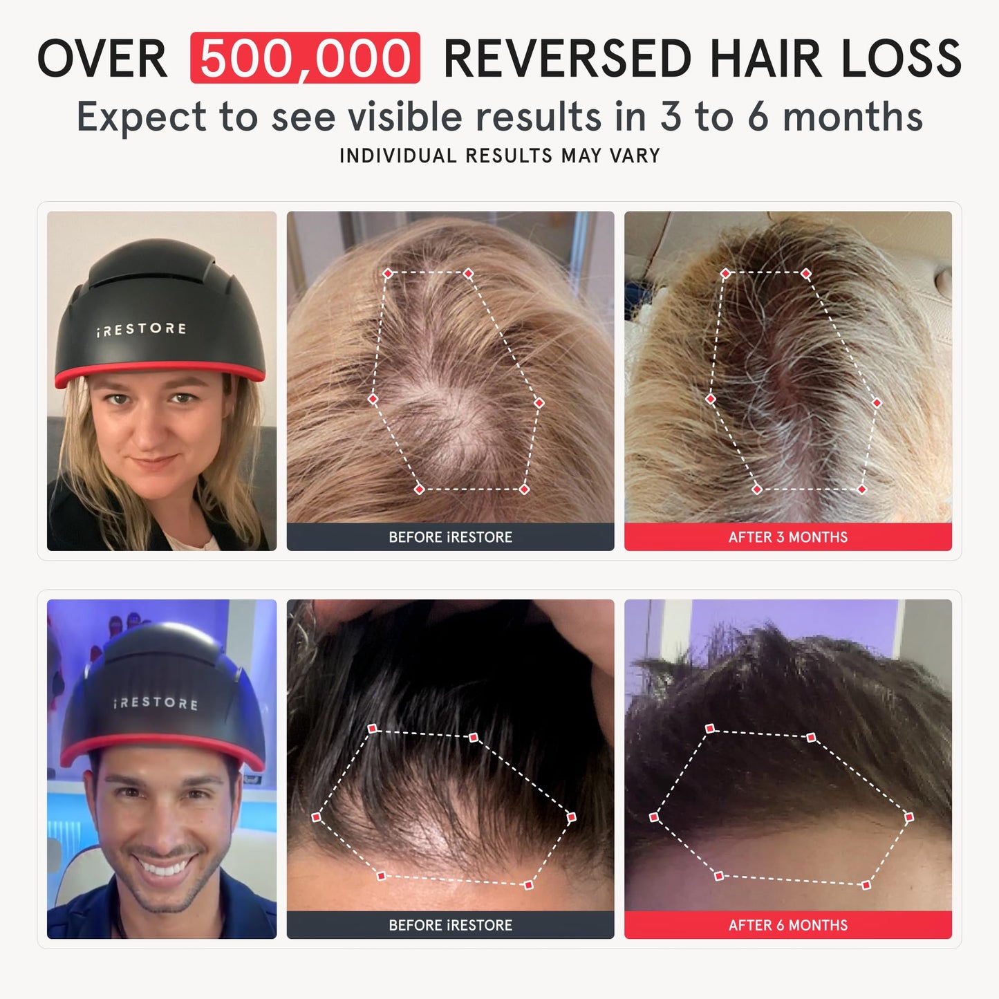 iRestore Elite - Laser Red Light Therapy for Hair Growth System - FDA Cleared Hair Loss, Hair Thinning & Alopecia Treatment for Men & Women - Laser Cap for Hair Regrowth Stimulates Denser Fuller Hair